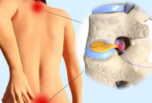 bel-ve-boyun-fitiginda-ameliyatsiz-cozum-