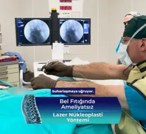 https://doktormuratkarakus.com/wp-content/uploads/2025/07/nukleoplasti-islemi-900x829-1-300x276.webp