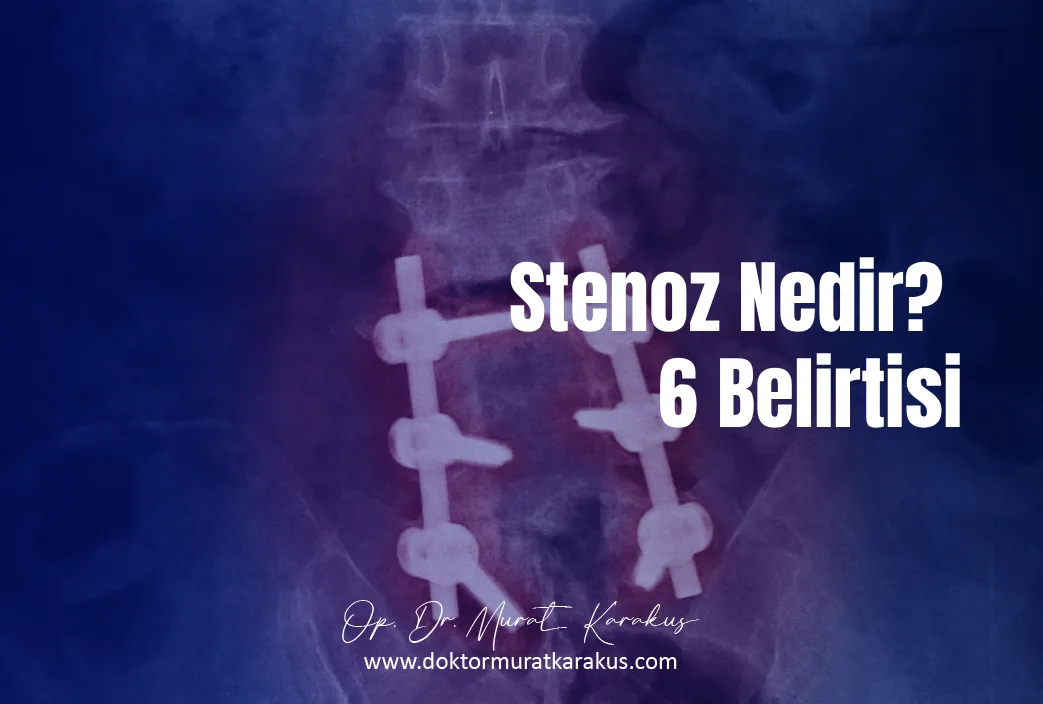 stenoz-nedir-