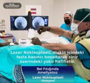 lazer-nukleoplasti-736x681-1.webp
