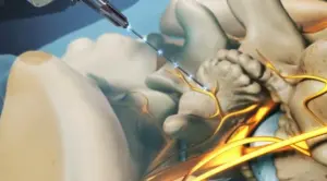 Kronik Bel Ağrısında Radyofrekans Tedavisi Görsel1