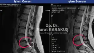 nukleoplasti-sonrasi-fitik-tekrarlar-mi