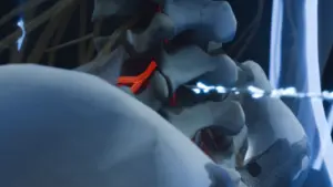 tekrarlayan-bel-fitigi-radyofrekans-